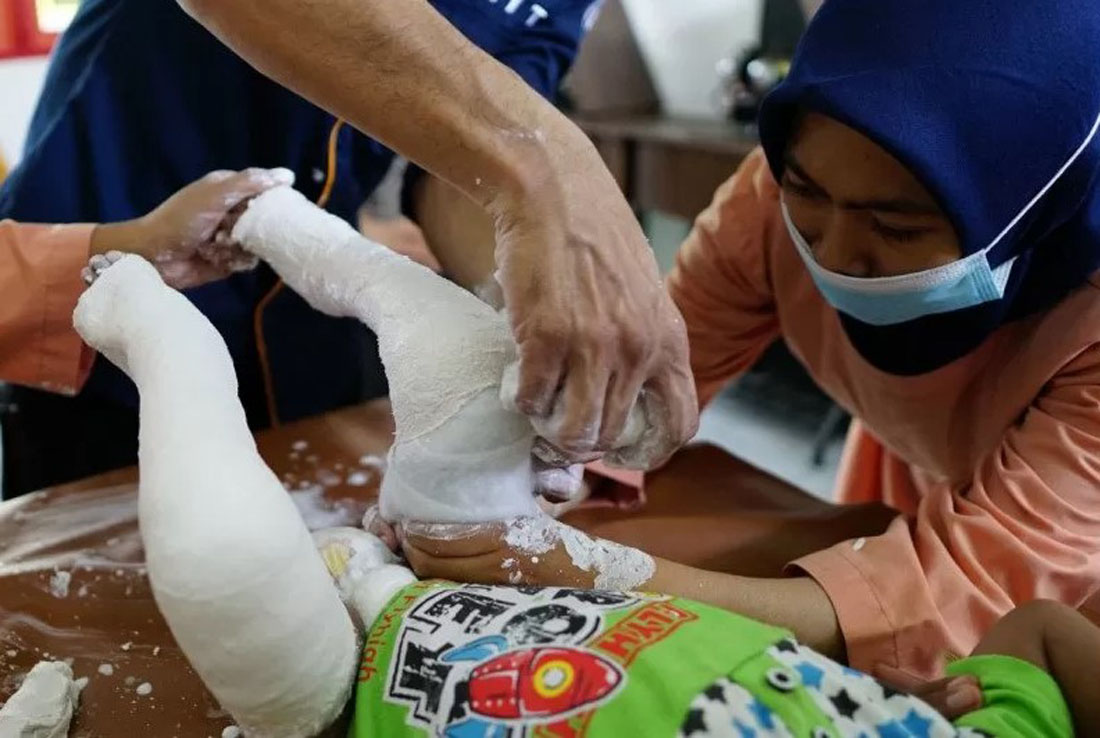 Kaki Pengkor di Lombok. (Foto: Arsip Yayasan Lombok Care) Kaki Pengkor di Lombok. (Foto: Arsip Yayasan Lombok Care)