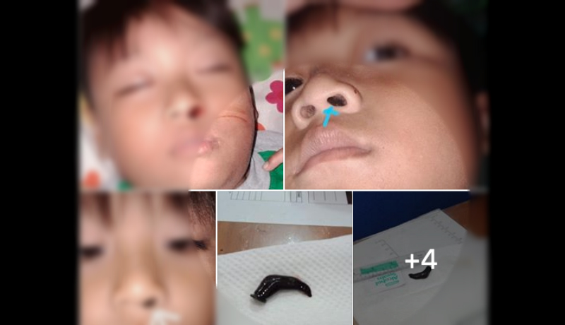 Seekor lintah bersarang di hidung bocah asal Solo ini. Penyebabnya diduga dia tidak membersihkan tubuhnya selesai berenang di kolam renang umum (Foto : Facebook Setyo Pe-Je Chelsea) Seekor lintah bersarang di hidung bocah asal Solo ini. Penyebabnya diduga dia tidak membersihkan tubuhnya selesai berenang di kolam renang umum (Foto : Facebook Setyo Pe-Je Chelsea)