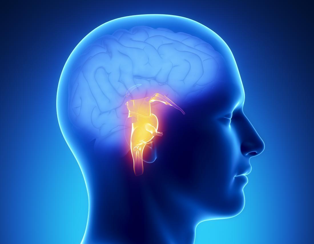 Ilustrasi stroke. (Medical News Today) Ilustrasi stroke. (Medical News Today)
