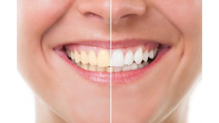 Tak Asal Putih, Simak Saran Dokter Gigi Sebelum Lakukan Veneer. Foto: Health Line Tak Asal Putih, Simak Saran Dokter Gigi Sebelum Lakukan Veneer. Foto: Health Line