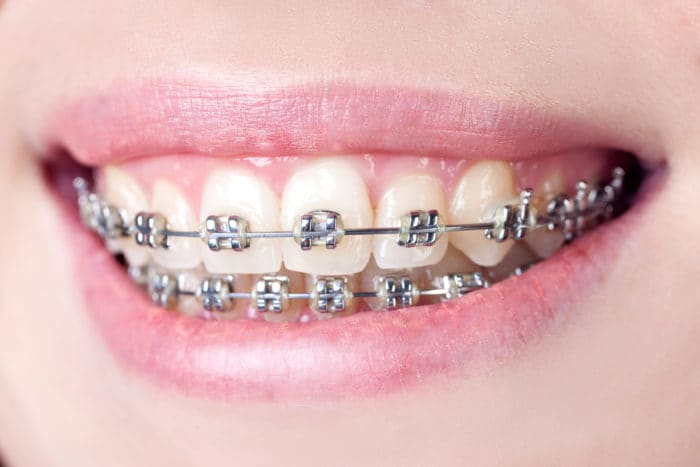 Behel. Foto: Shutterstock Behel. Foto: Shutterstock